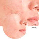 Exfoliante-Revox-Acido-Salicilico-30-Ml