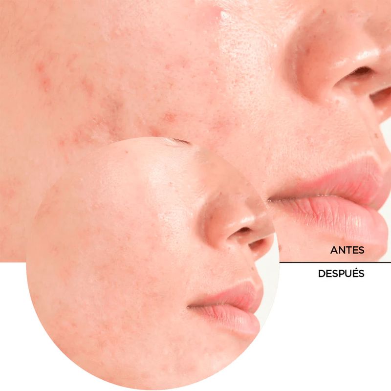 Exfoliante-Revox-Acido-Salicilico-30-Ml